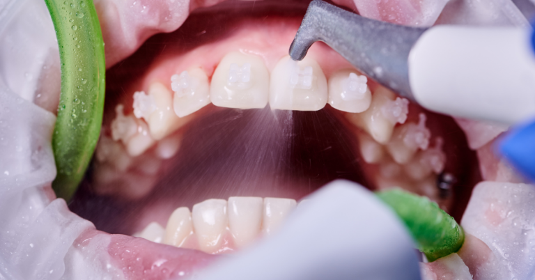 Fogkőeltávolítás2