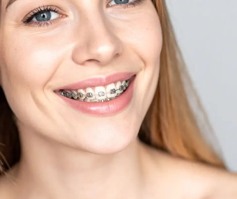 rogzitett_felnott_fogszabalyozas